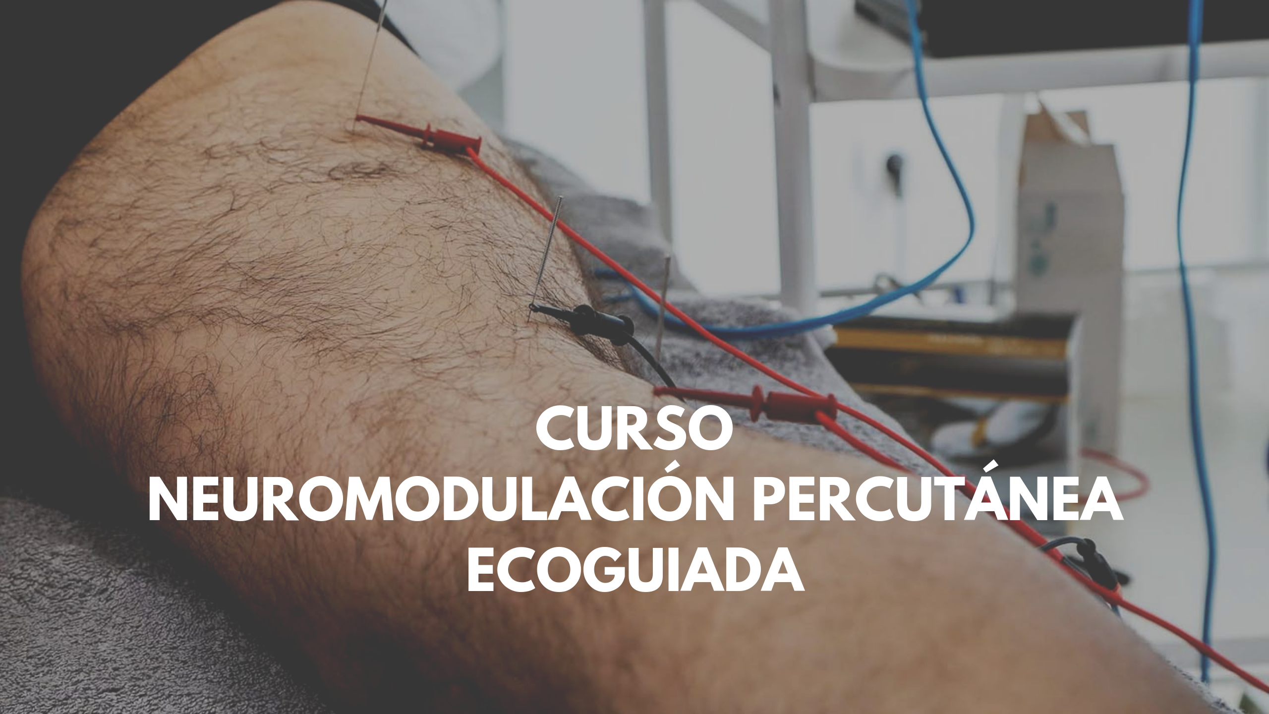 Neuromodulación percutánea